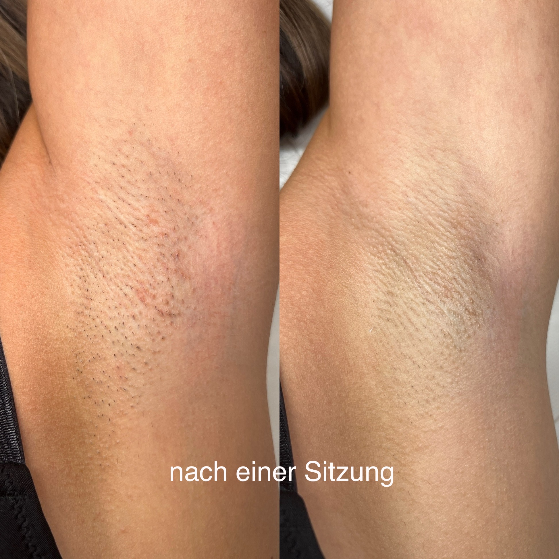 Laser Haarentfernung Erfurt