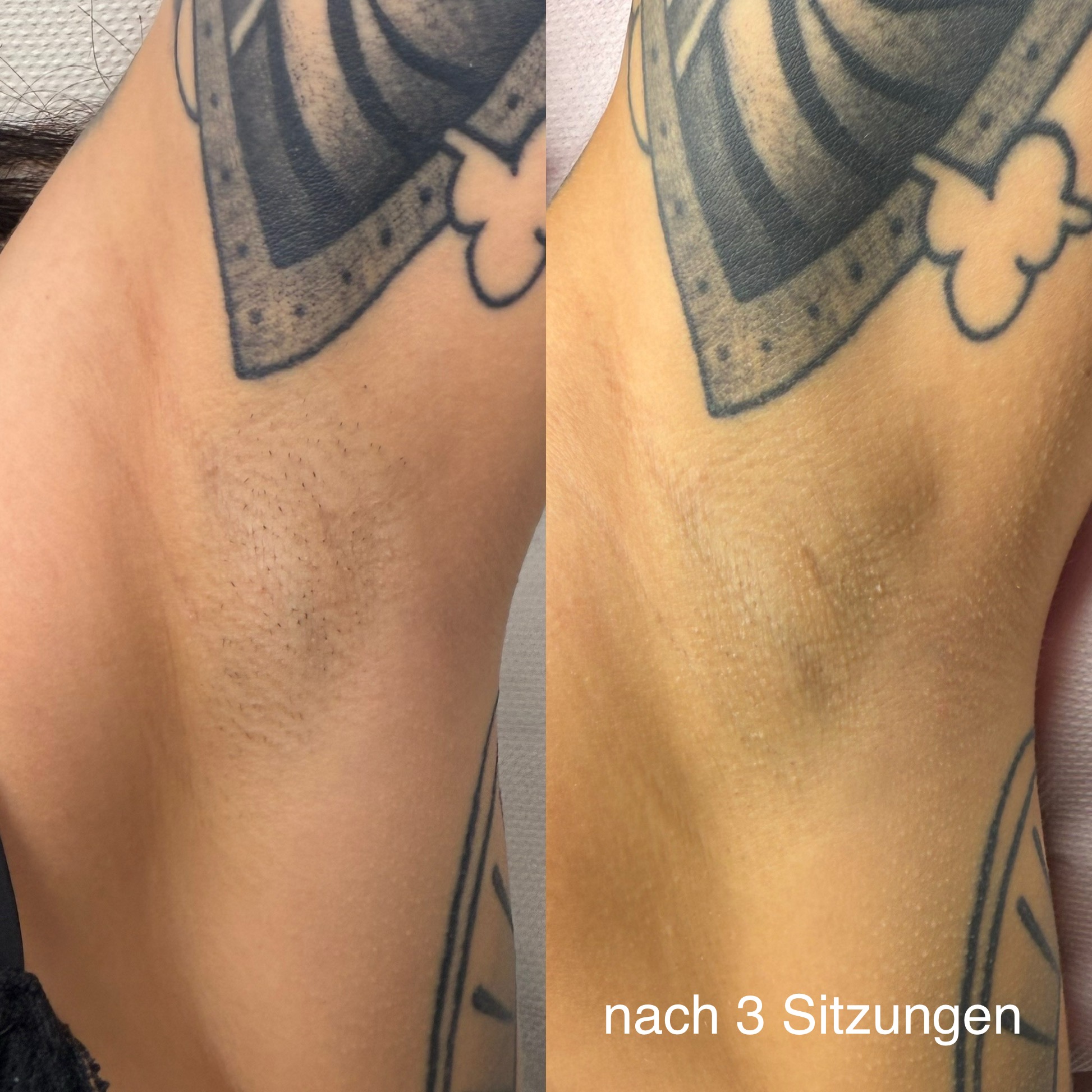 Laser Haarentfernung Erfurt