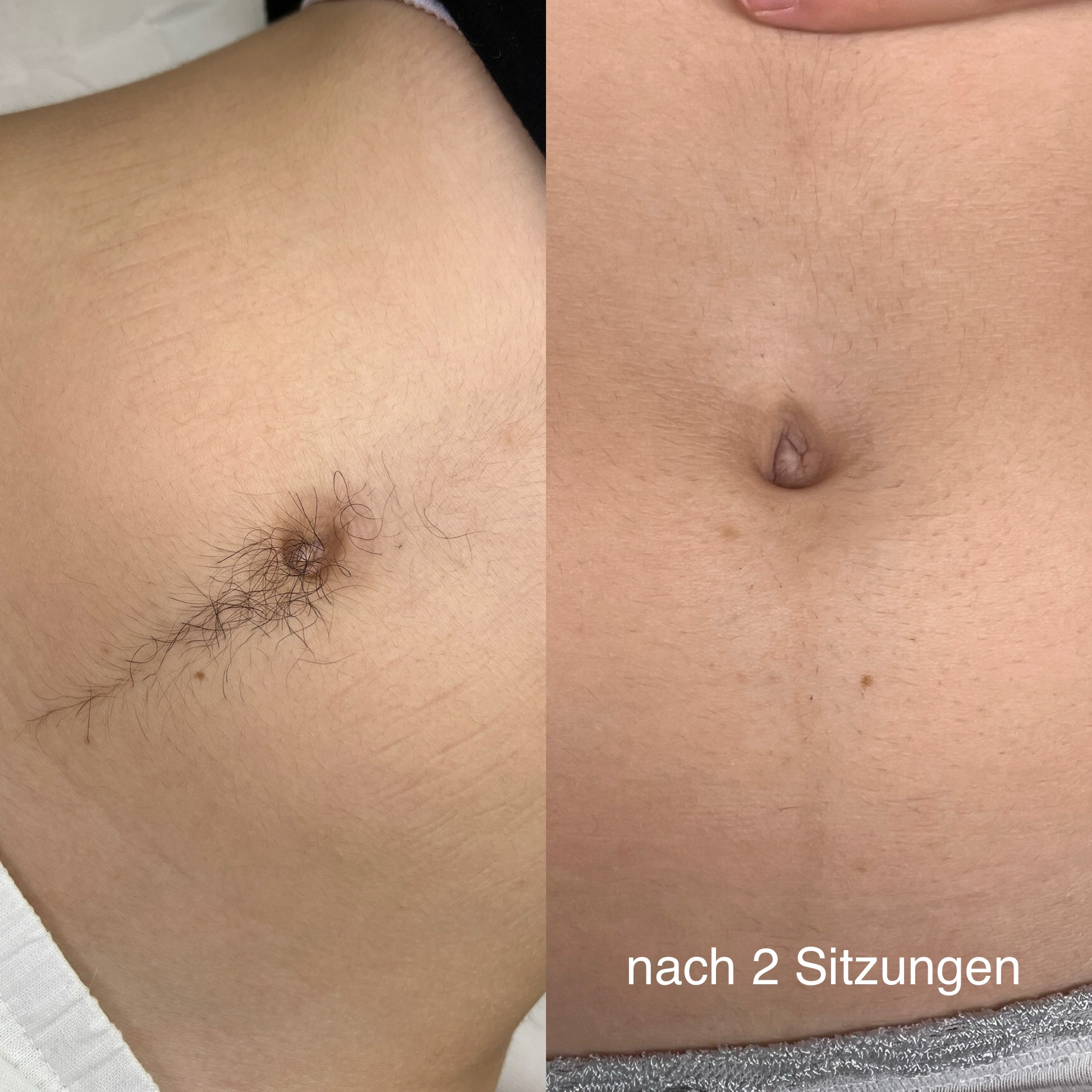 Laser Haarentfernung Erfurt