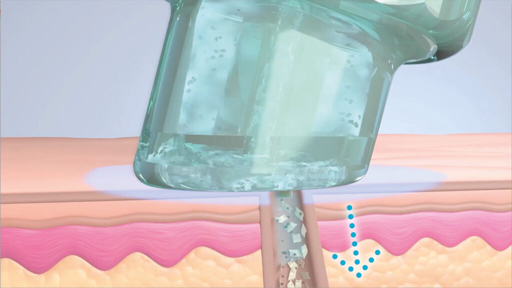 HydraFacial Erfurt