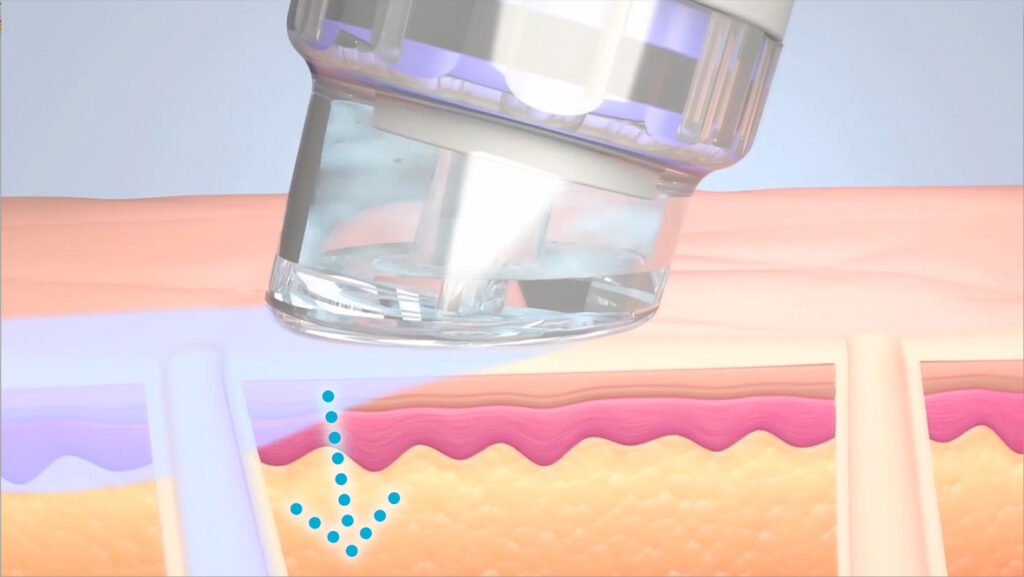 HydraFacial Erfurt
