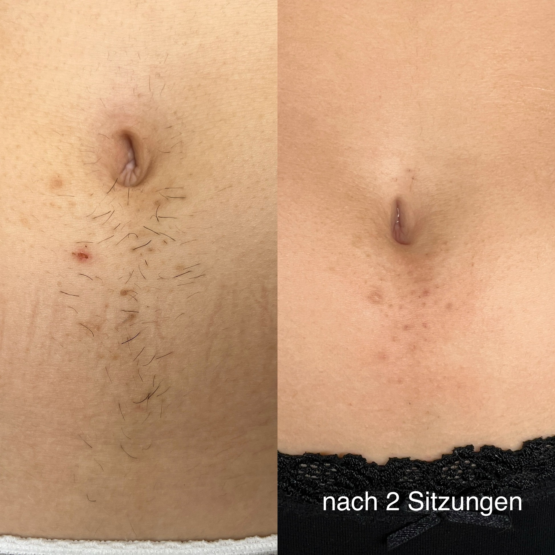 Laser Haarentfernung Erfurt